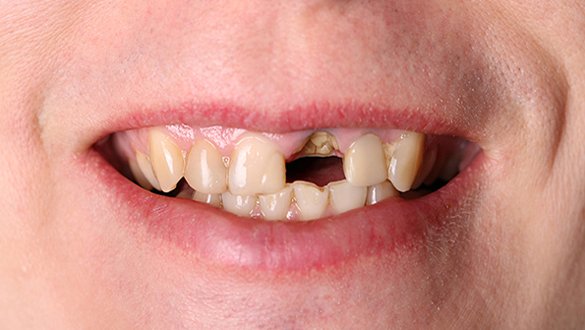 Teeth Before Treatment